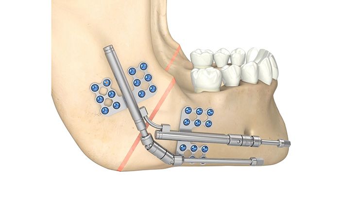 CMF surgery - Zurich Wood Distractor