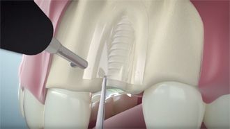Dental - resorbable osteosynthesis SonicWeld Dental video