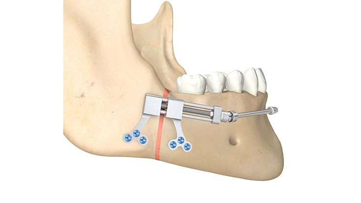 CMF surgery - Horizontal Distractors