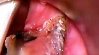 Cordectomía Micro Point