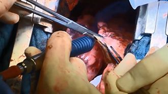 Surgical Laser Systems - NdYAG laser Limax thorax surgery video