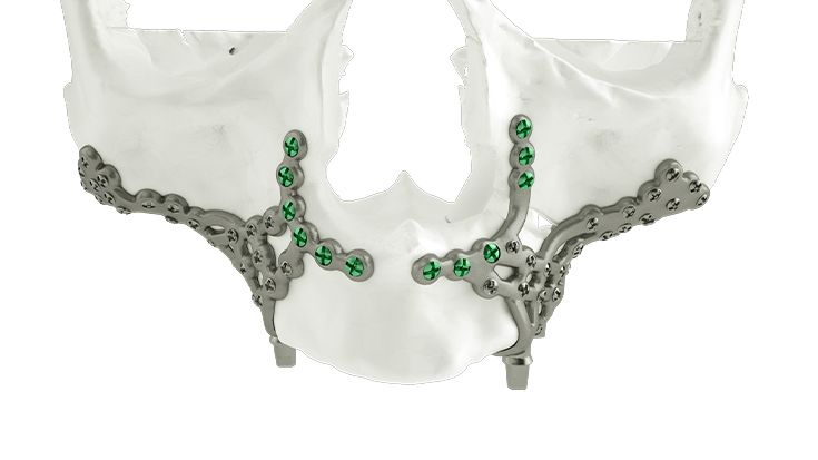 Treatment of an atrophic maxilla