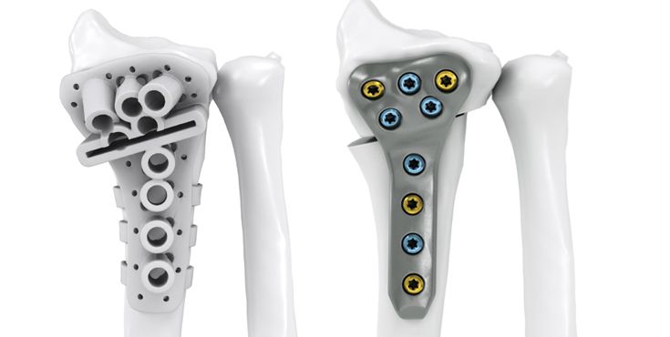 IPS Implants® Radius Reconstruction extra-articular