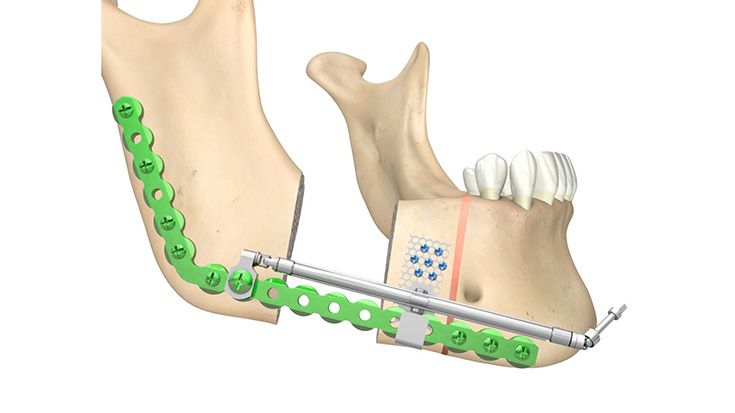 Distractores por transporte Herford