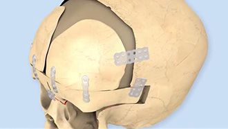 Técnica quirúrgica SonicWeld® – Craneosinostosis