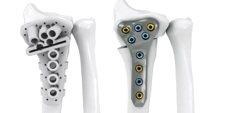 IPS Implants® Radius Reconstruction  extraarticular
