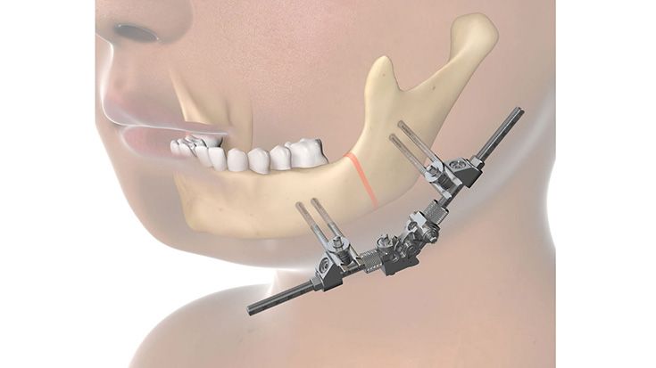CMF surgery - 3D Xternal Distractor Multidirectional