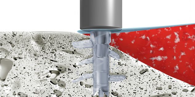 SonicWeld Rx® Dental procedimiento