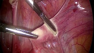 Electrosurgery - marSeal - Anwendung in der Gynäkologie Teil 1