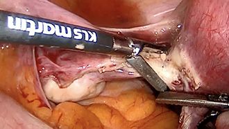 Electrosurgery - Vessel sealing marSeal5 plus total laparoscopic