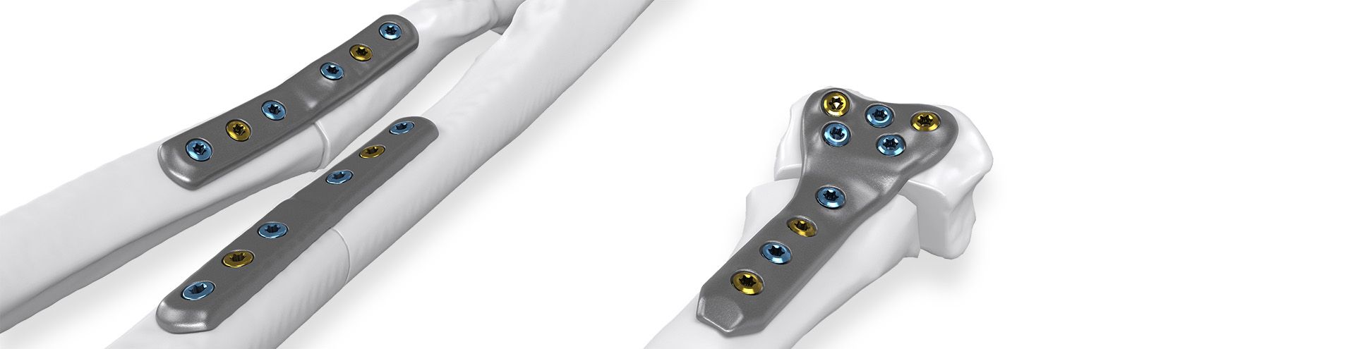 IPS Implants® Radius