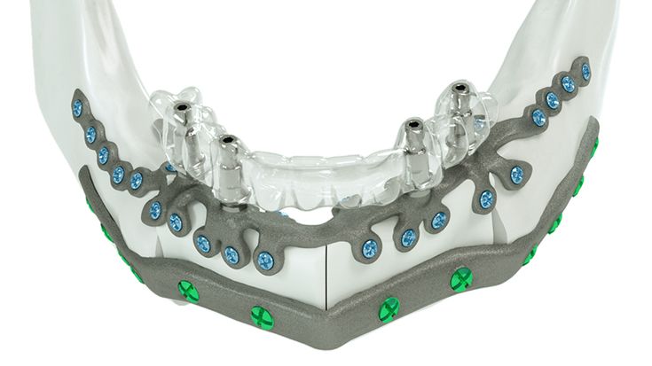 Versorgung des Unterkiefers