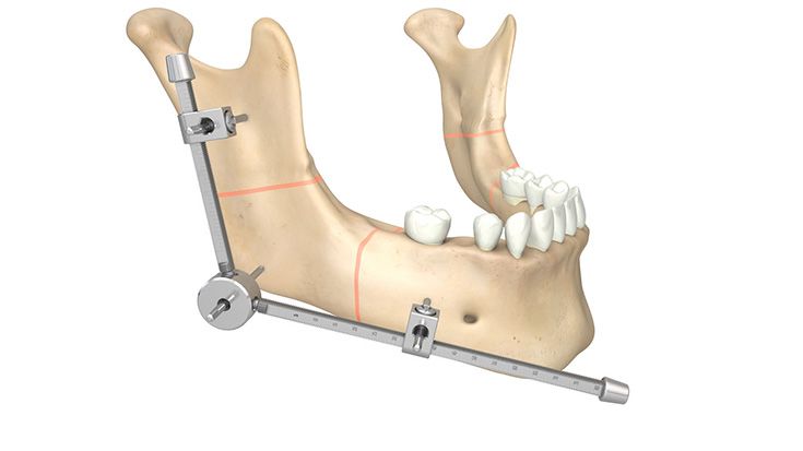 Distractores según Molina