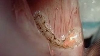 Cordectomía con escáner Micro Point