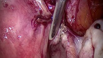 Electrosurgery - marSeal - Anwendung in der Gynäkologie Teil 2