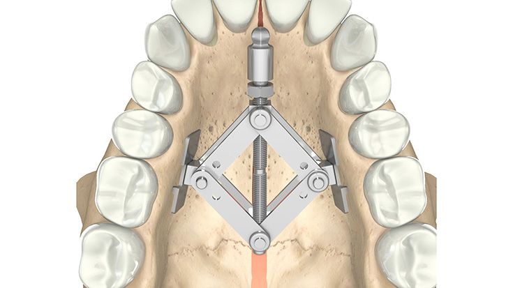 CMF surgery - Rotterdam Palatal Distractor