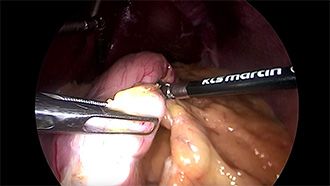 Electrosurgery - Vessel sealing marSeal5 plus sleeve gastrectomy