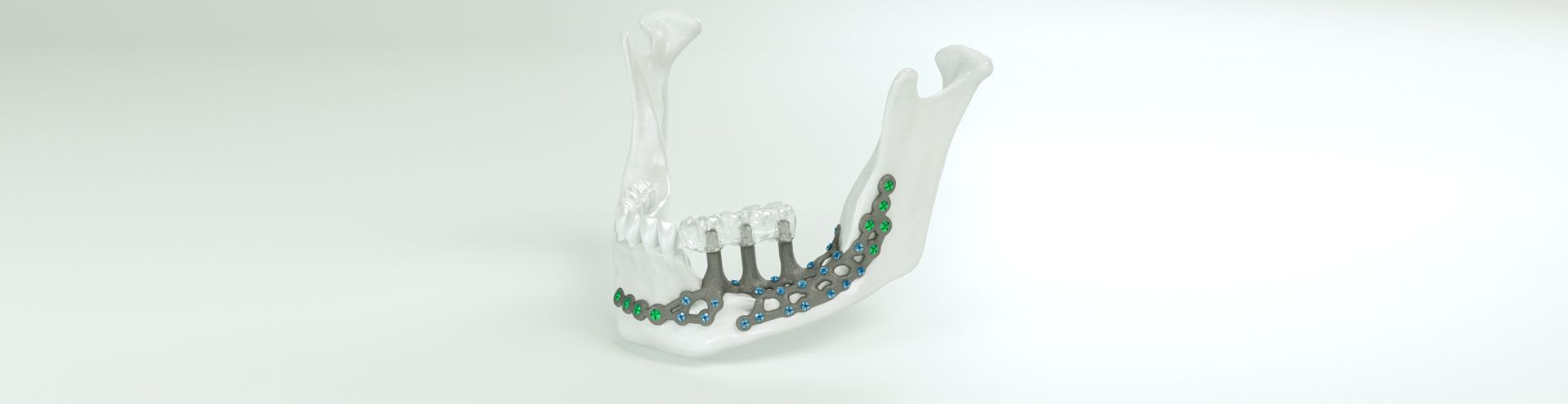 IPS Implants® Preprosthetic