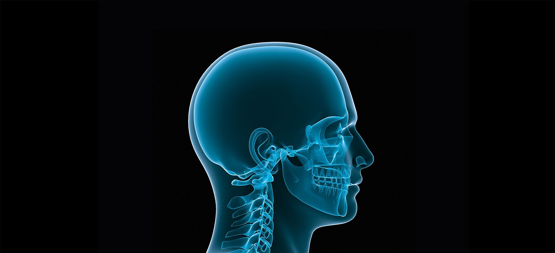 Implantes y sistemas de implante cirugía cráneo-maxilofacial