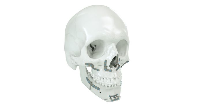 IPS Implants® Orthognathics