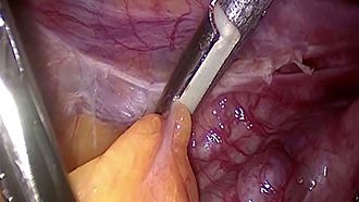 Electrosurgery - marSeal - Anwendung in der Gynäkologie Teil 3