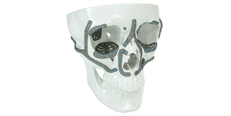 IPS Implants® Midface Orbita