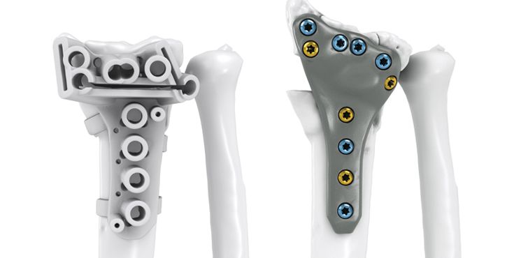 IPS Implants® Radius Reconstruction intra-articular