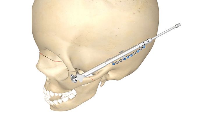 Distractores Kawamoto