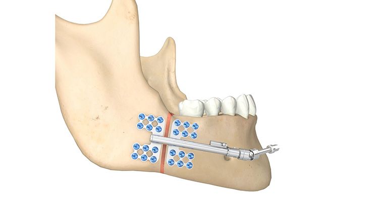 CMF surgery - Zurich II Distractors