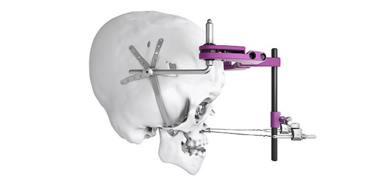 IPS Implants® Distraction  