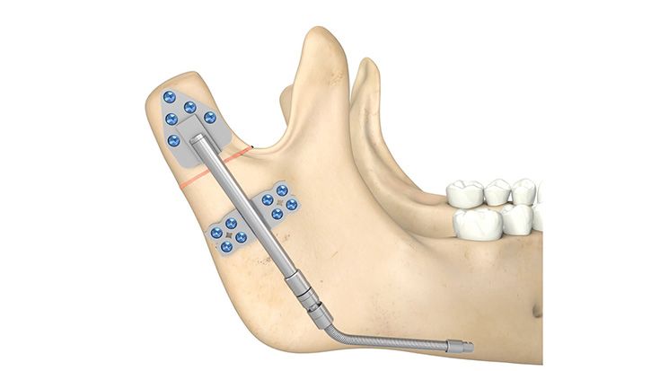 Distractores de rama por transporte
