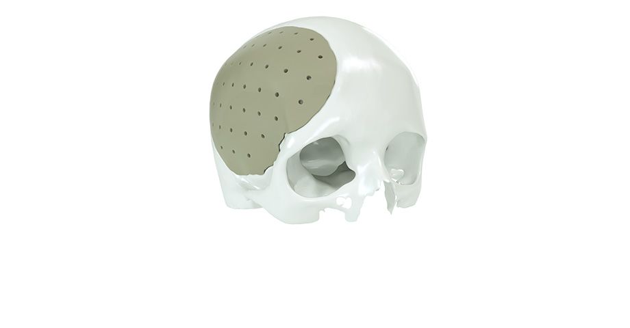 Cirugía cráneo-maxilofacial - craneal