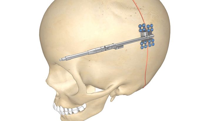 Posterior-Cranial-Vault-Distraktoren