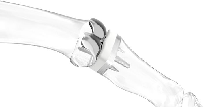 Handsurgery - CapFlex