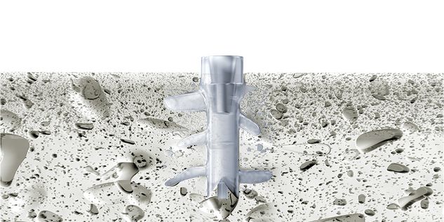 SonicWeld Rx® Dental procedimiento