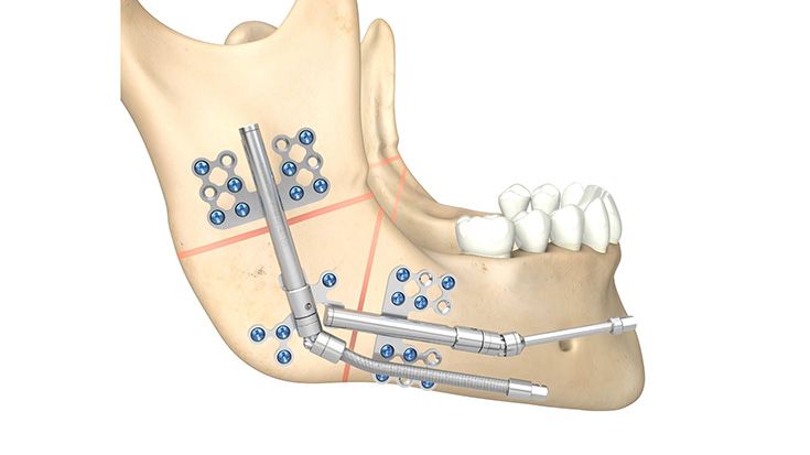 Distractores Zúrich bidireccionales
