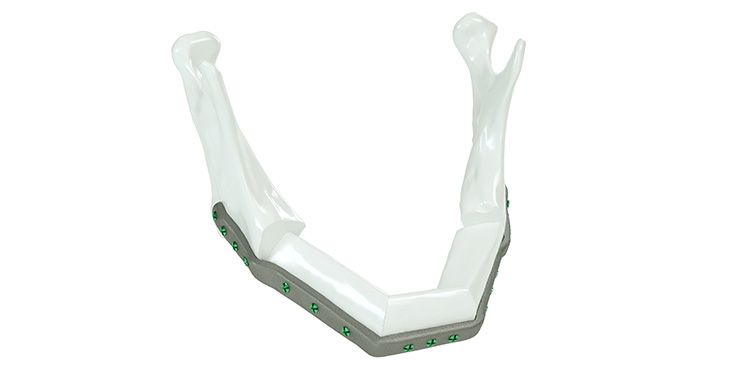 IPS Implants® Mandible Reconstruction