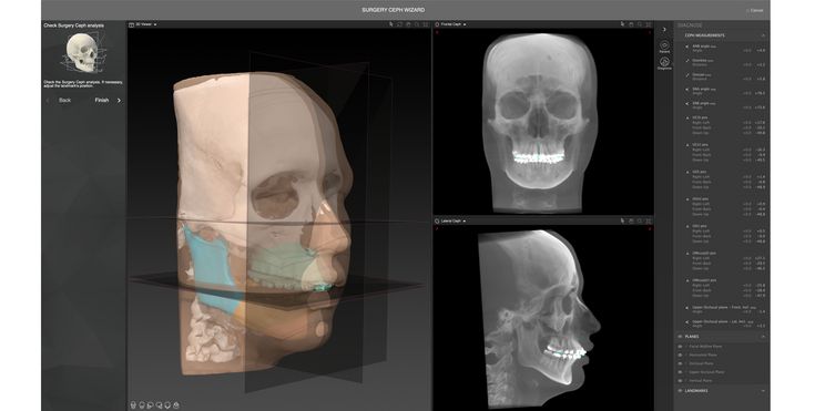 IPS CaseDesigner® - Trabajo de precisión