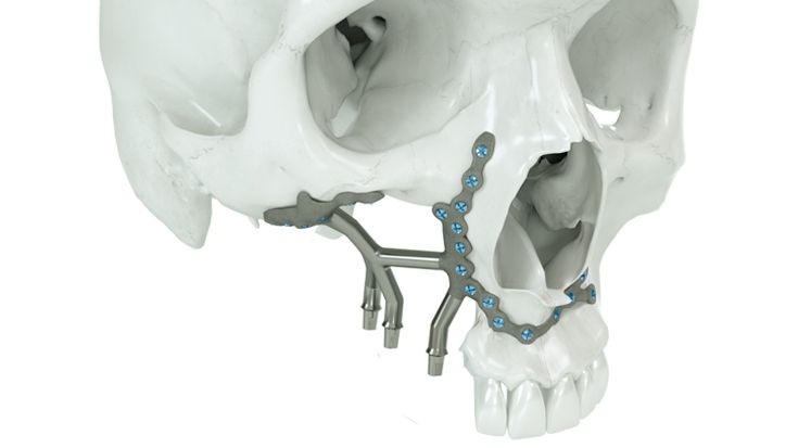 Versorgung des Oberkiefers rechts