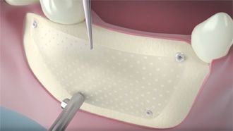 Dental - resorbable osteosynthesis SonicWeld Dental video