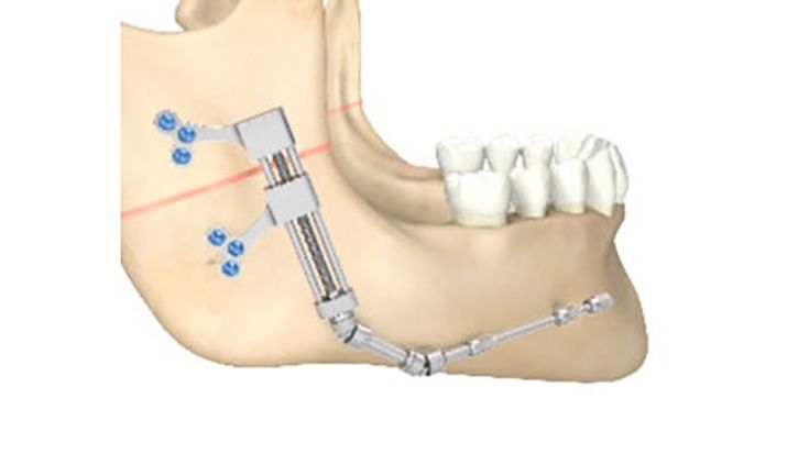 CMF surgery - Ramus Distractors