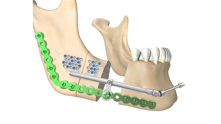 CMF surgery - ThreadLock Transport Distractor