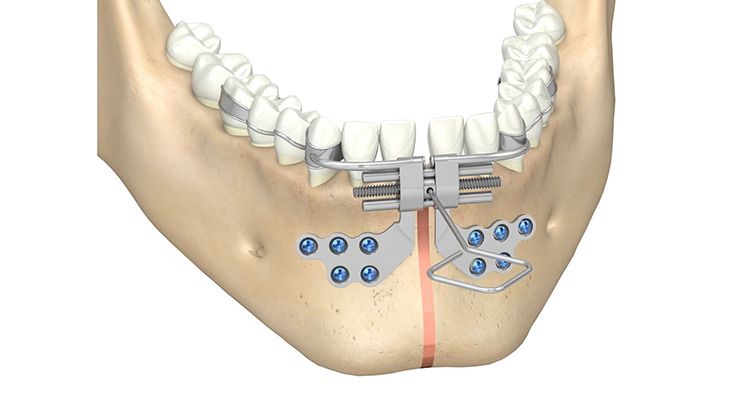 Bologna Midline Distraktor