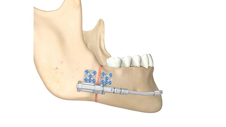Mandibula Telescoping Distraktoren