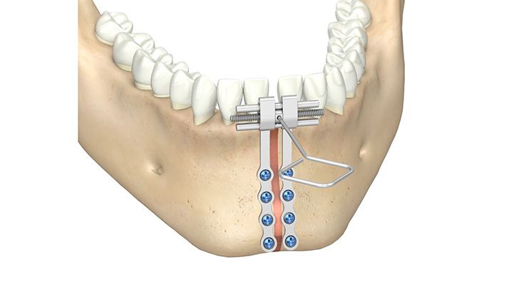 CMF surgery - Rotterdam Midline Distractor