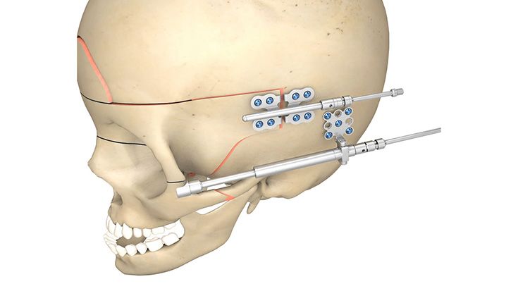CMF surgery - Arnaud Cranio-Orbital Distractor