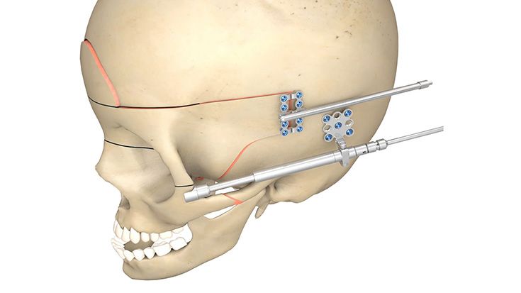 CMF surgery - Arnaud Cranio-Orbital Distractor
