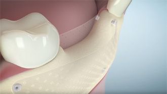 Dental - resorbable osteosynthesis SonicWeld Dental video