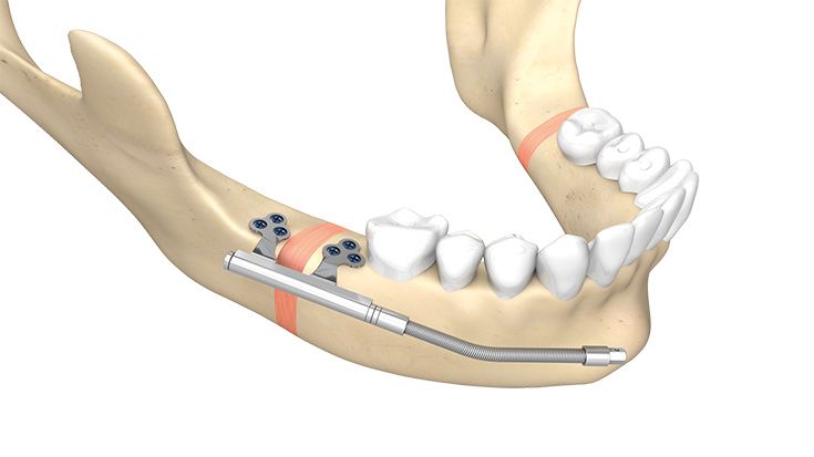 Zürich Pediatric Ramus Distraktoren