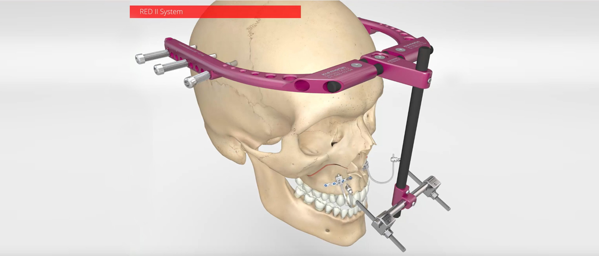 Distraction Osteogenesis – 32 options from KLS Martin Group